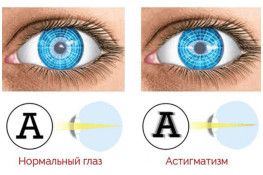 Кампанія Acuvue щодо астигматизму «Що знаєте ви про астигматизм?»